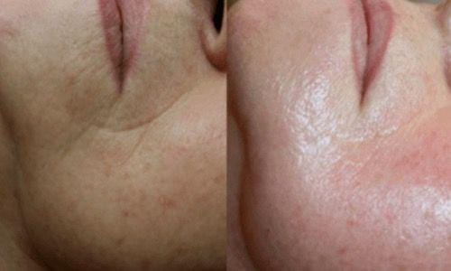 1000205694 Microneedling resultaten arnhem