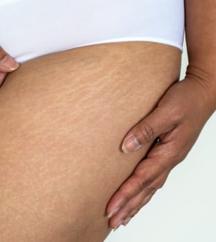 DIENST - Cellulitis, striemen en littekens Huidkliniek in Arnhem