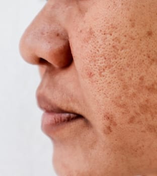 DIENST - pigmentatie IPL resultaten