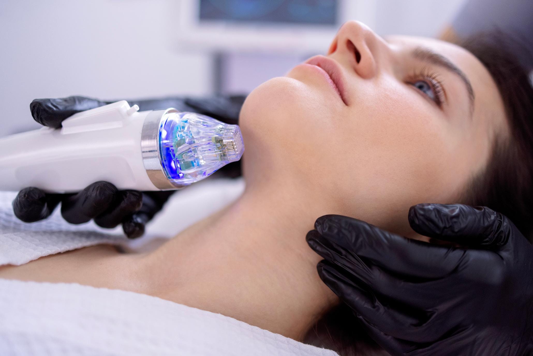 Microneedling huidkliniek 3 Huidkliniek omgeving Apeldoorn
